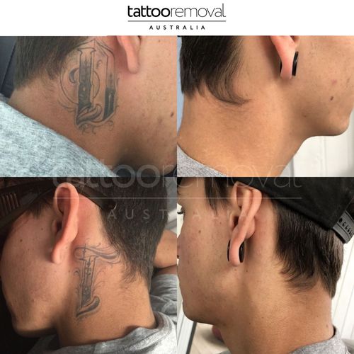  Tattoo Removal Gold Coast | Tattoo Removal Australia