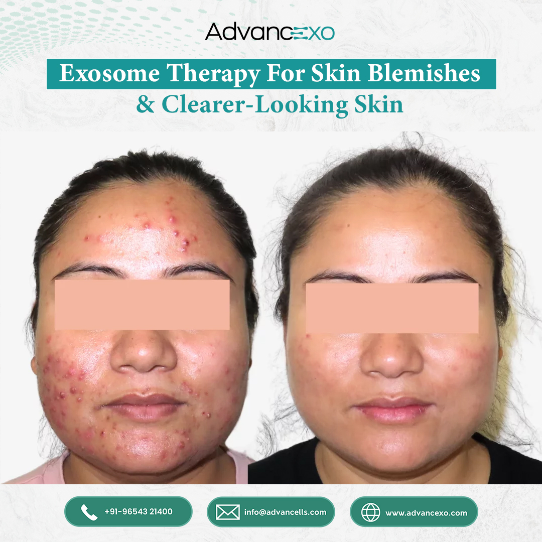  Exosome Therapy for Skin Blemishes and Clearer-Looking Skin