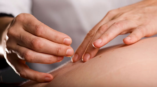  Acupuncture Therapy in Millbrae, Ca