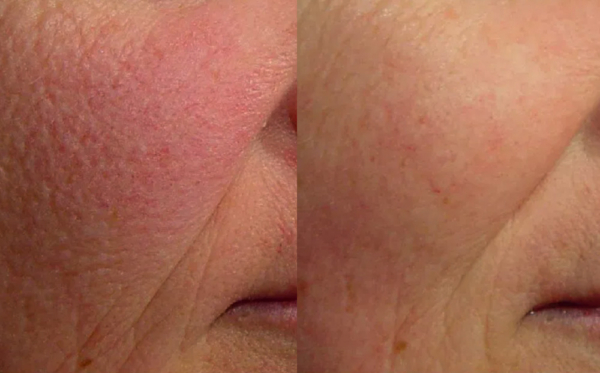  Professional Laser Genesis Treatment in Vancouver for Lasting Skin Renewal | Euro Charm Skincare and Body Clinic