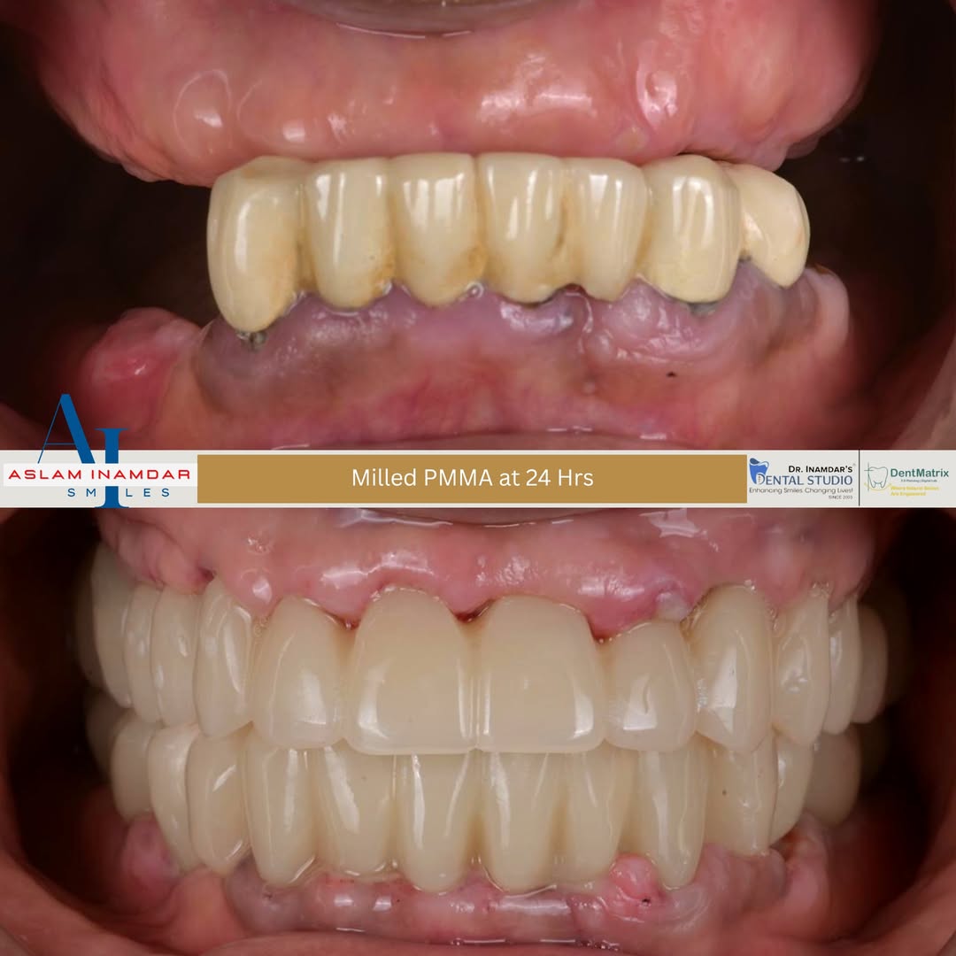  Full Mouth Rehabilitation Cost In Mumbai