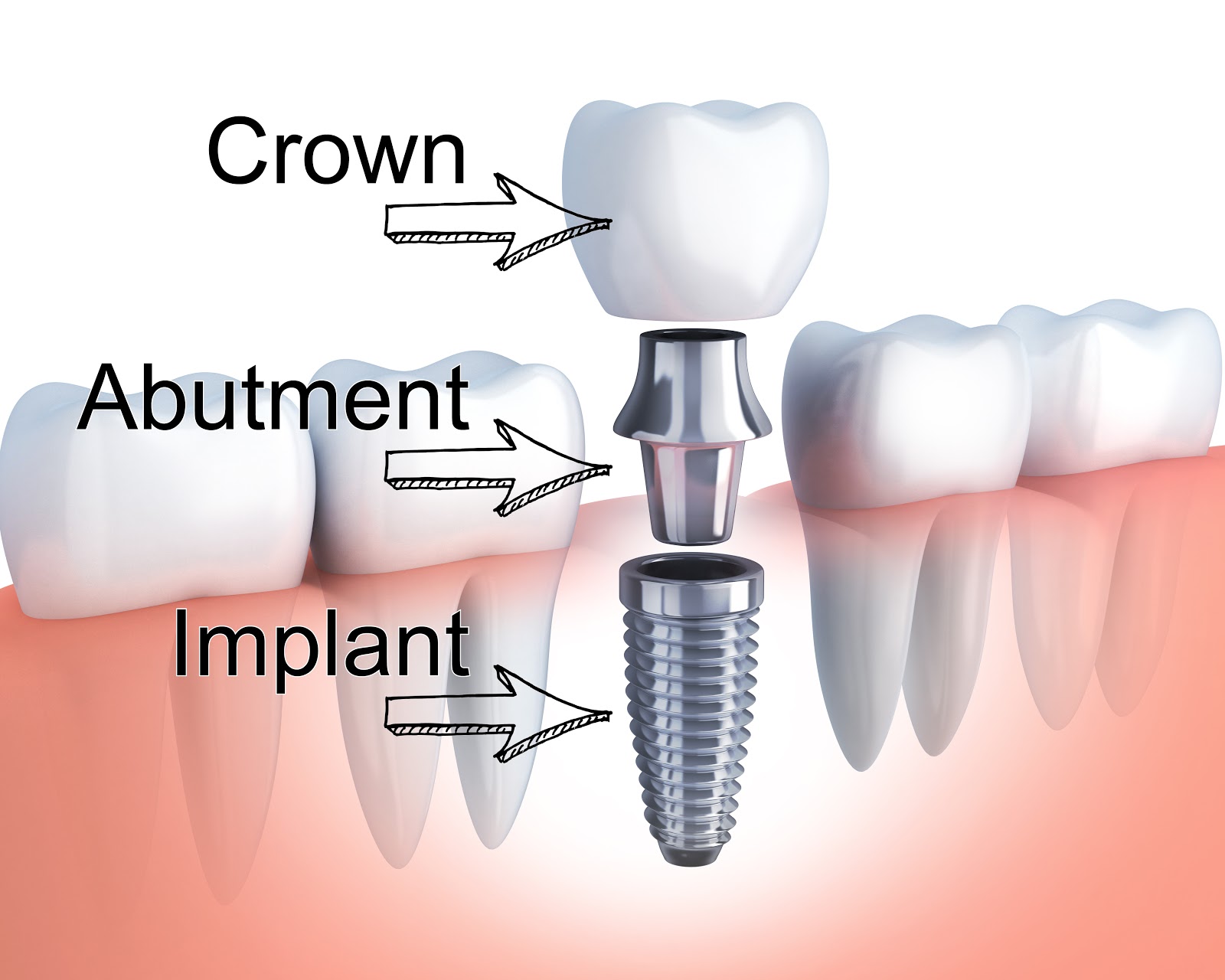  Permanent Solution for Missing Teeth and Smile Restoration