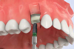  Have Dental Implants in China: Quality and Comfort