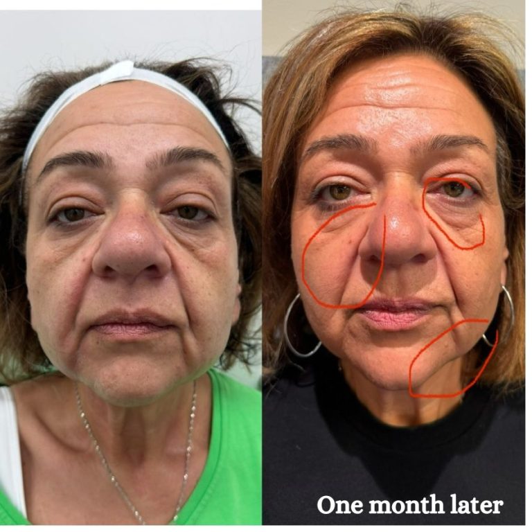  HIFU Treatment Melbourne | Cosmetic Tattooing Melbourne