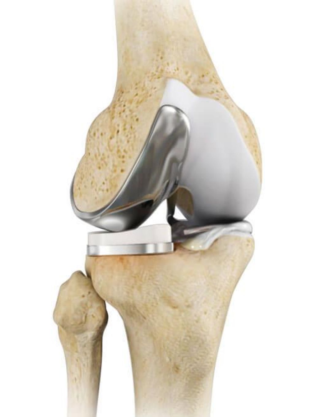  Robotic Unicondylar Knee Replacement