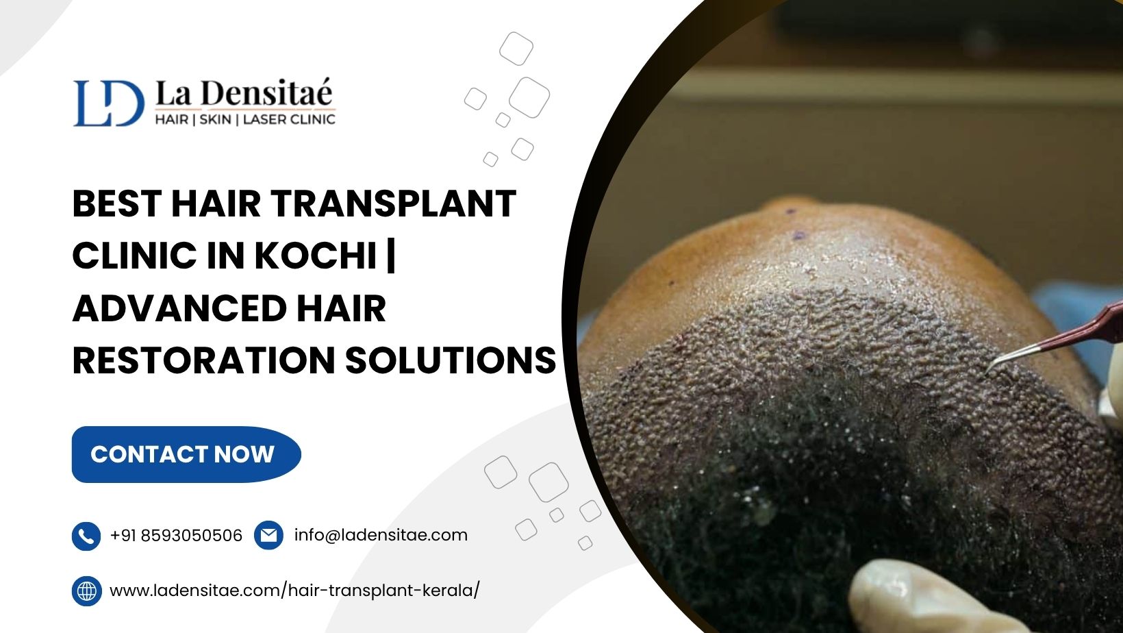  Best Hair Transplant Clinic in Kochi | Advanced Hair Restoration Solutions