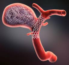  Coiling for Brain Aneurysm | Minimally Invasive