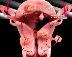  Uterine Fibroid Embolisation | Minimally Invasive Fibroid Treatment