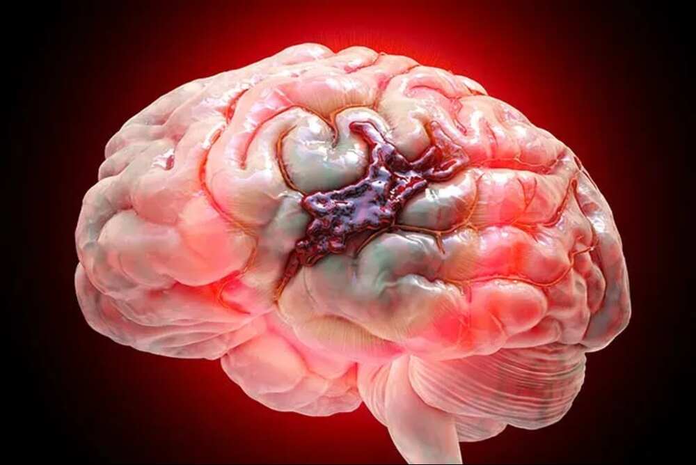  Brain Hemorrhage Operation | Advanced Treatment Solutions