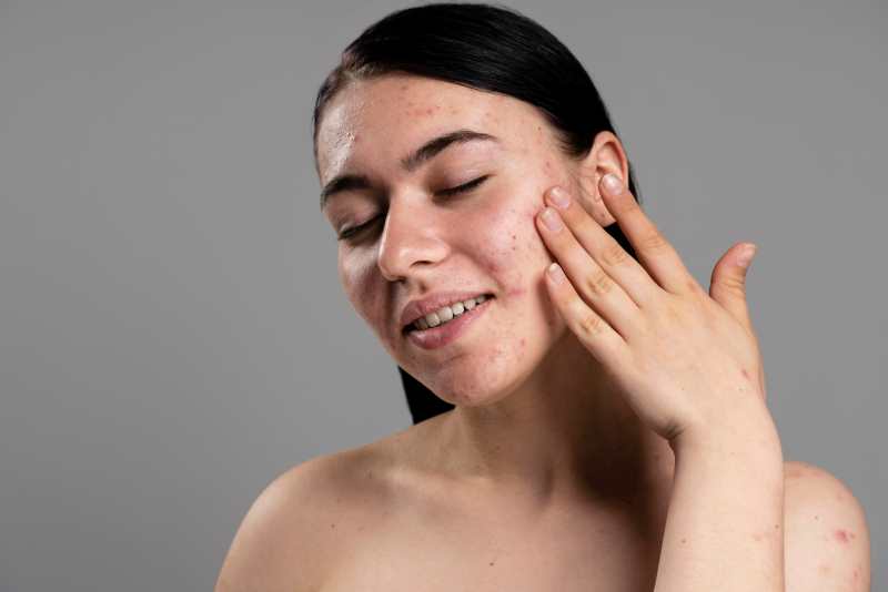 Discover the Benefits of Azelaic Acid for Acne Scars