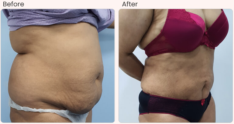 Liposuction Surgery in Delhi - Dr Rajat Gupta