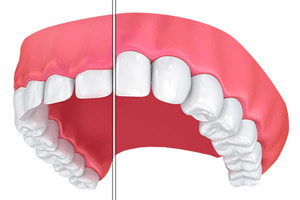  Cosmetic Gum Contouring China for a More Balanced and Natural-Looking Smile