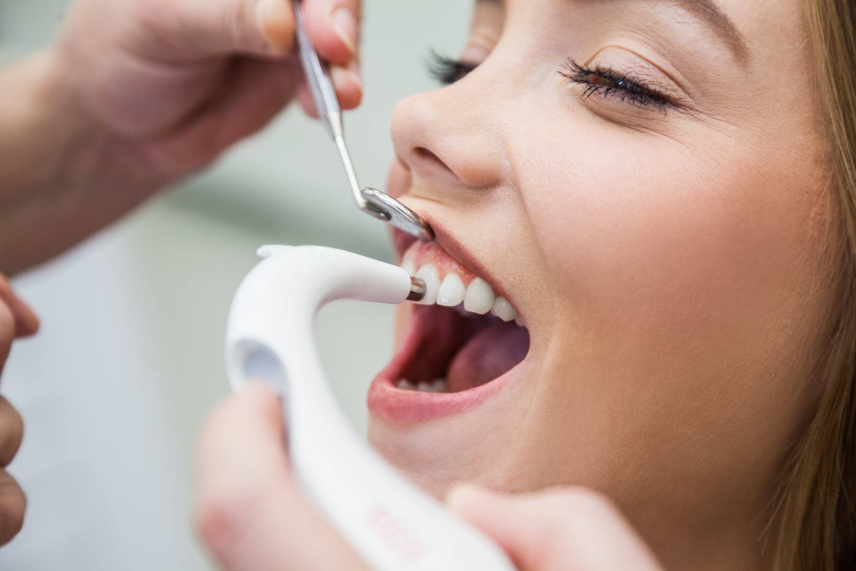  Teeth Cleaning in Pune | Professional Dental Scaling