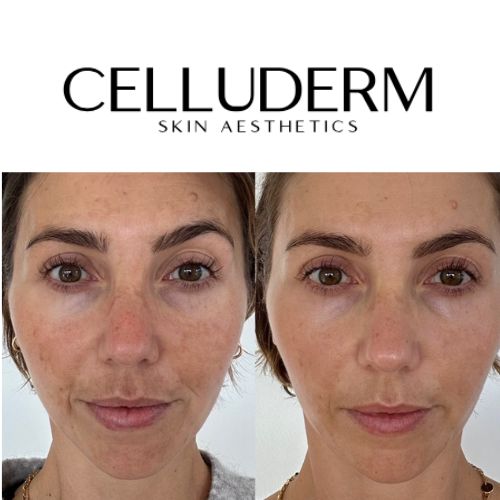  Skin Clinic St Kilda – Personalised Skin Treatments at CelluDerm