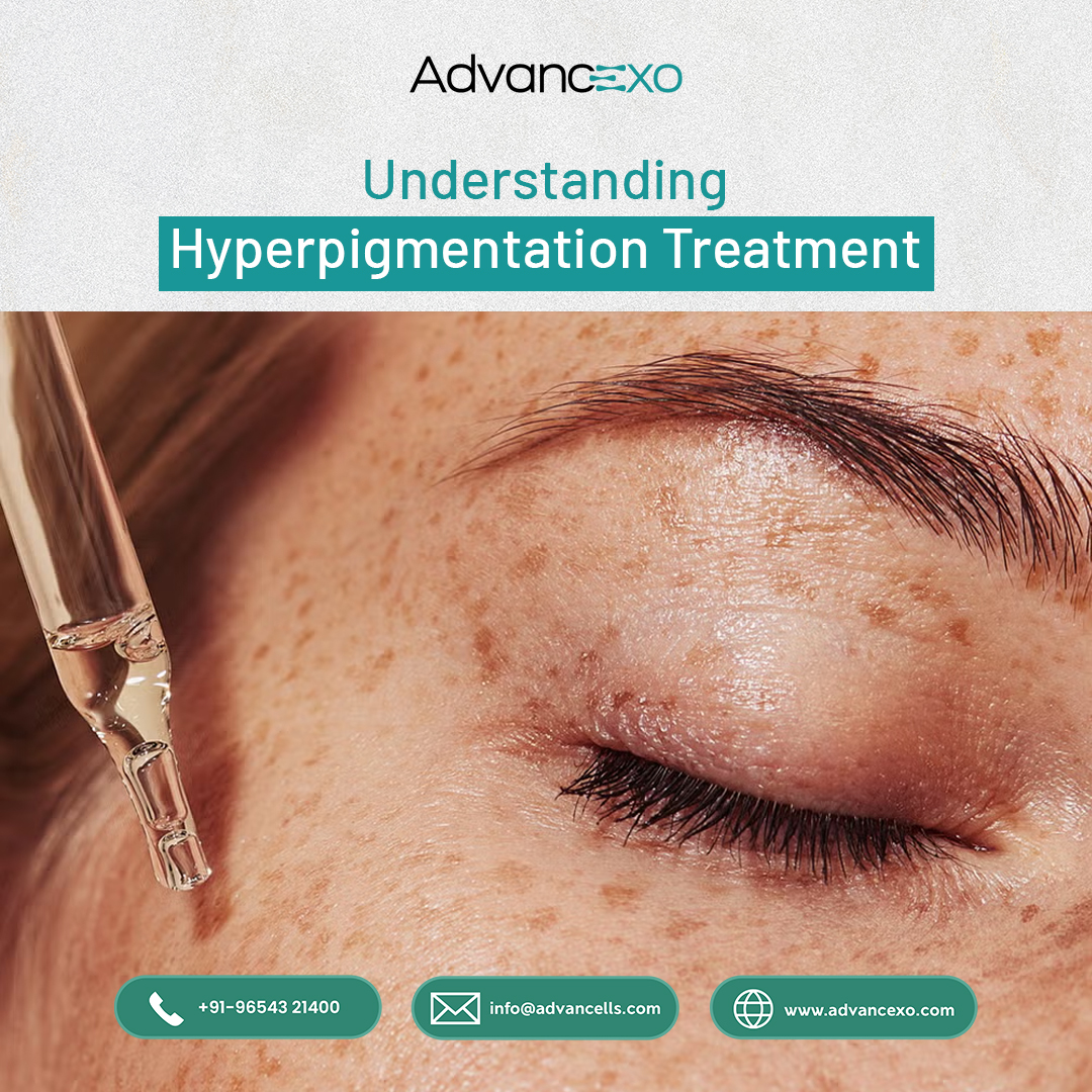  Understanding Hyperpigmentation Treatment