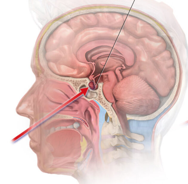  Persistent Cushing’s Disease After Surgery: Understanding the Two Most Common Failure Patterns