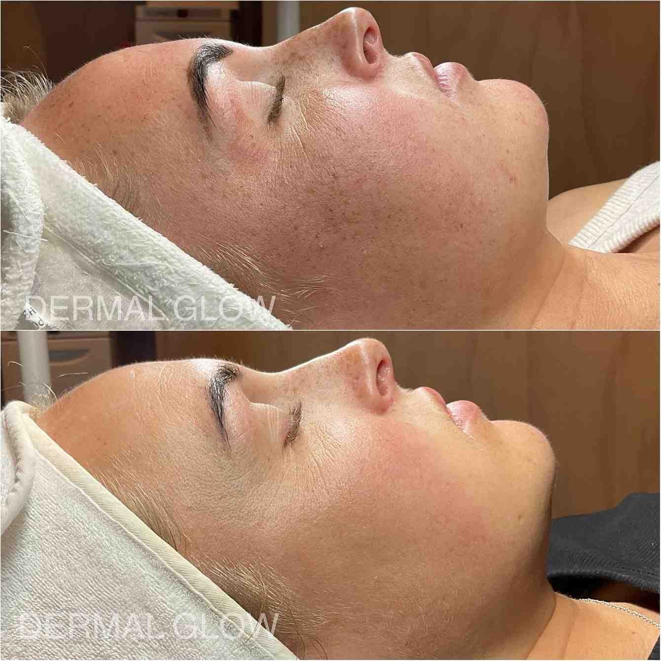  DMK Enzyme Facial: How Does It Improve Skin Health?