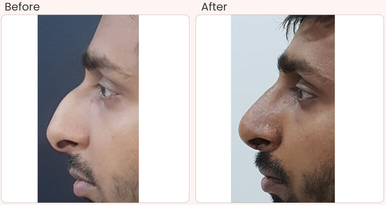  Rhinoplasty Surgery in Delhi - Dr Rajat Gupta