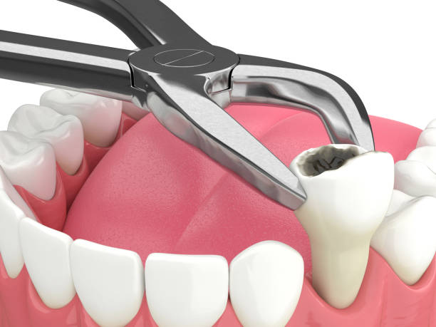  Wisdom Tooth Extraction in Pune | Safe & Painless Tooth Removal