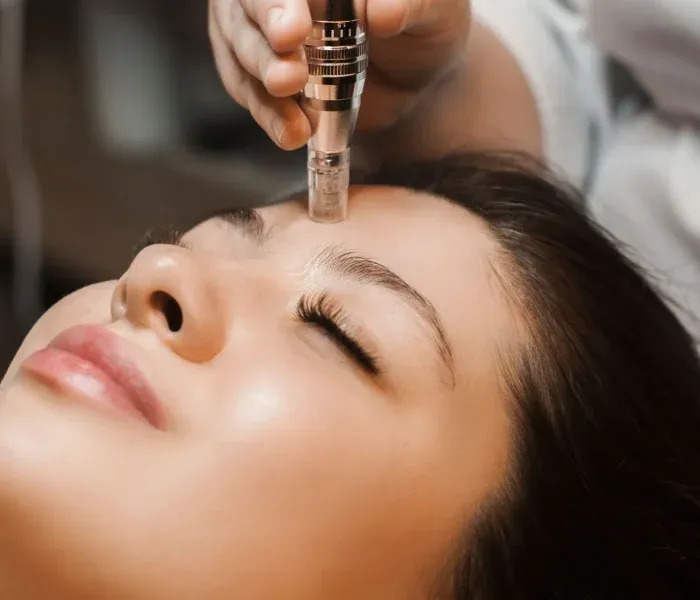 Face Microneedling Experts in Highbury London Today