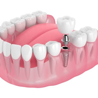  Dental Implants Bromley With Friendly Local Care