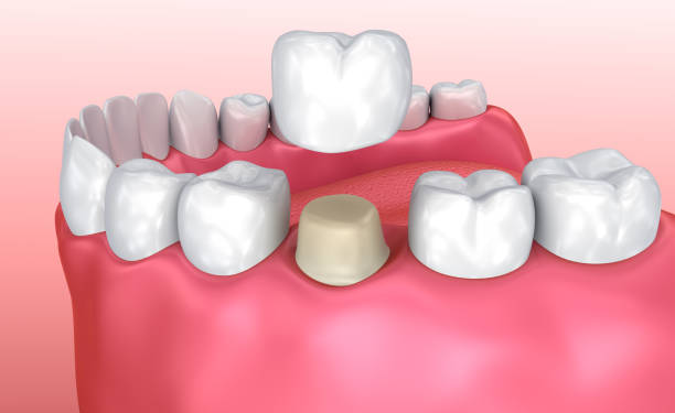  Best Dental Crowns in Pune | Expert Crown Treatment
