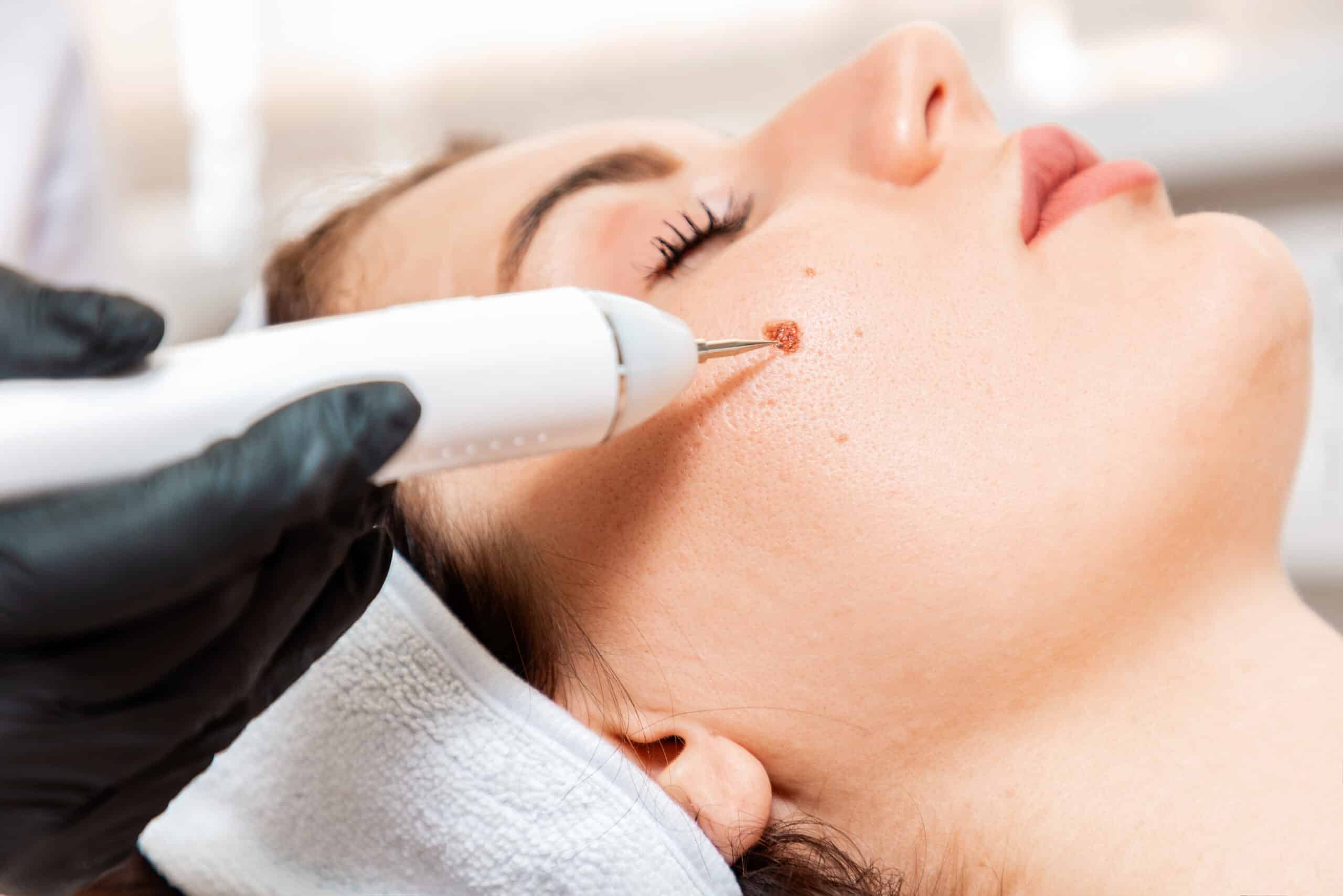  Mesotherapy Treatment in Coquitlam for Glowing Skin | Euro Charm Skincare and Body Clinic