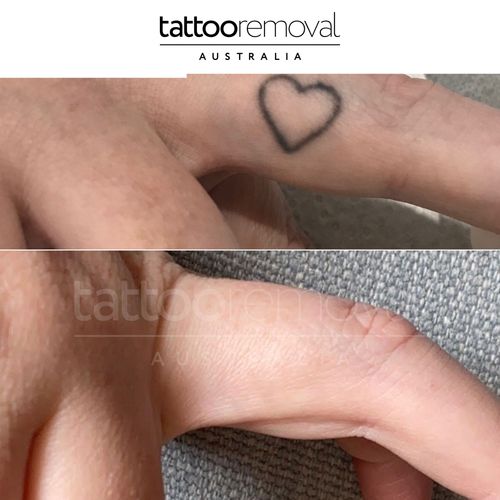  Tattoo Removal Brisbane | Safe & Professional Laser Tattoo Removal