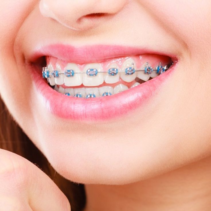  Braces Treatment in Pune | Affordable Dental Braces