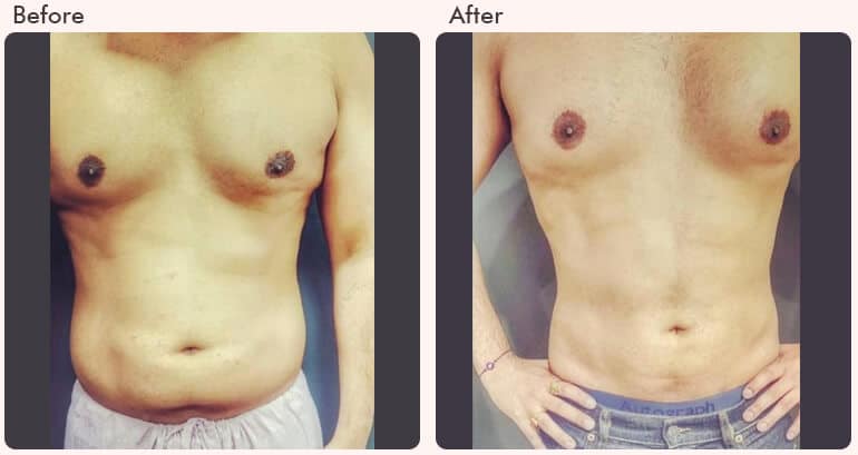  Liposuction Surgeon in Delhi - Dr Rajat Gupta