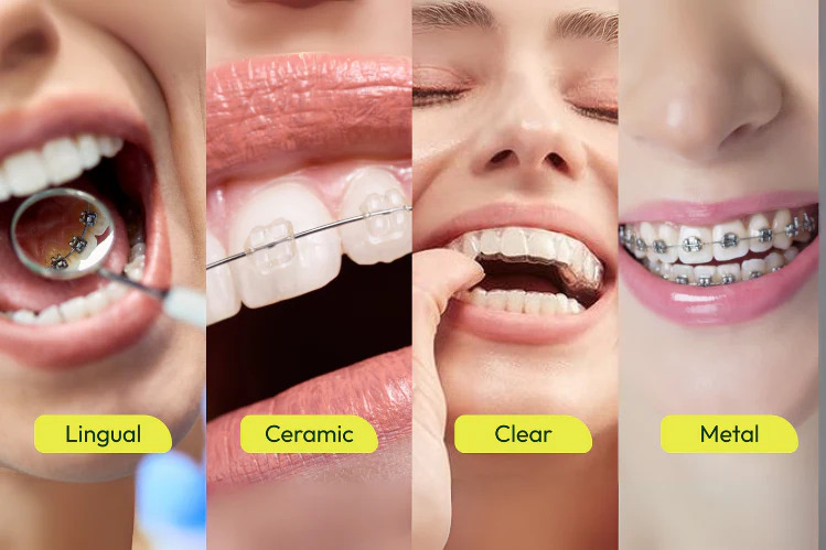  Affordable Braces for Teeth Treatment Cost Guide