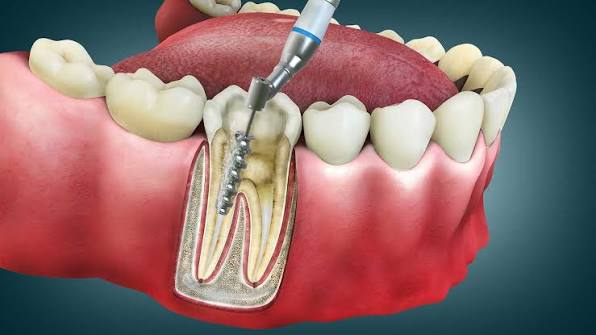 Root Canal Treatments
