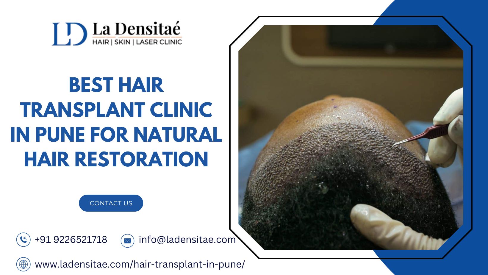  Best Hair Transplant Clinic in Pune for Natural Hair Restoration