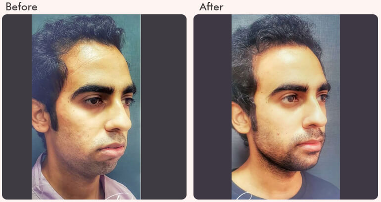  Chin Augmentation in Delhi - Dr Rajat Gupta