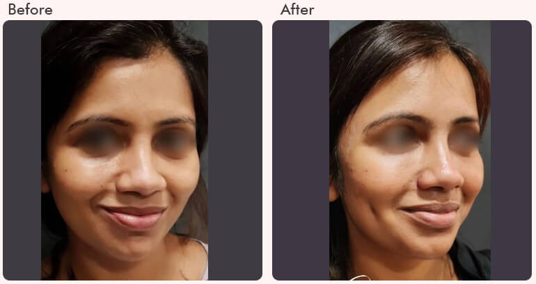  Dimple Creation Surgery in Delhi - Dr Rajat Gupta