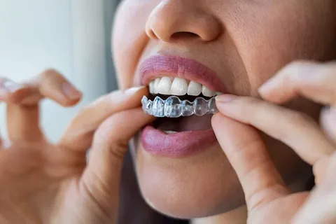  Clear Aligners in Pune | Invisible Teeth Aligners | DR. BILAL’S DENTAL CLINIC