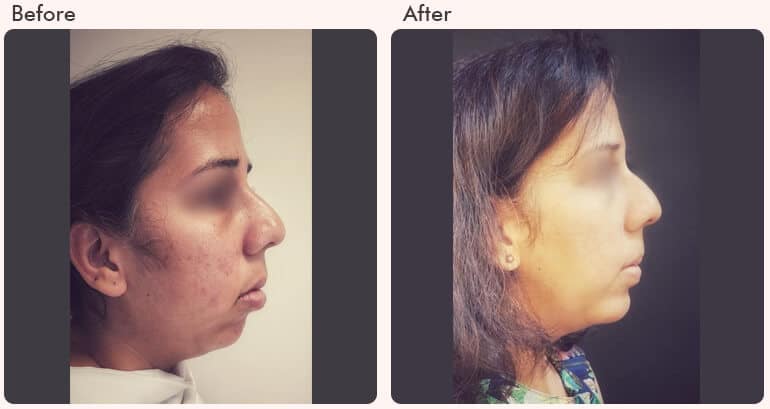  Chin Augmentation in Delhi - Dr Rajat Gupta