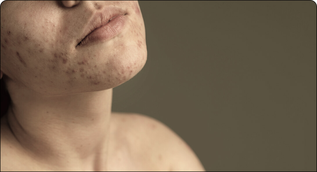  Acne Treatment in Kalyan Nagar