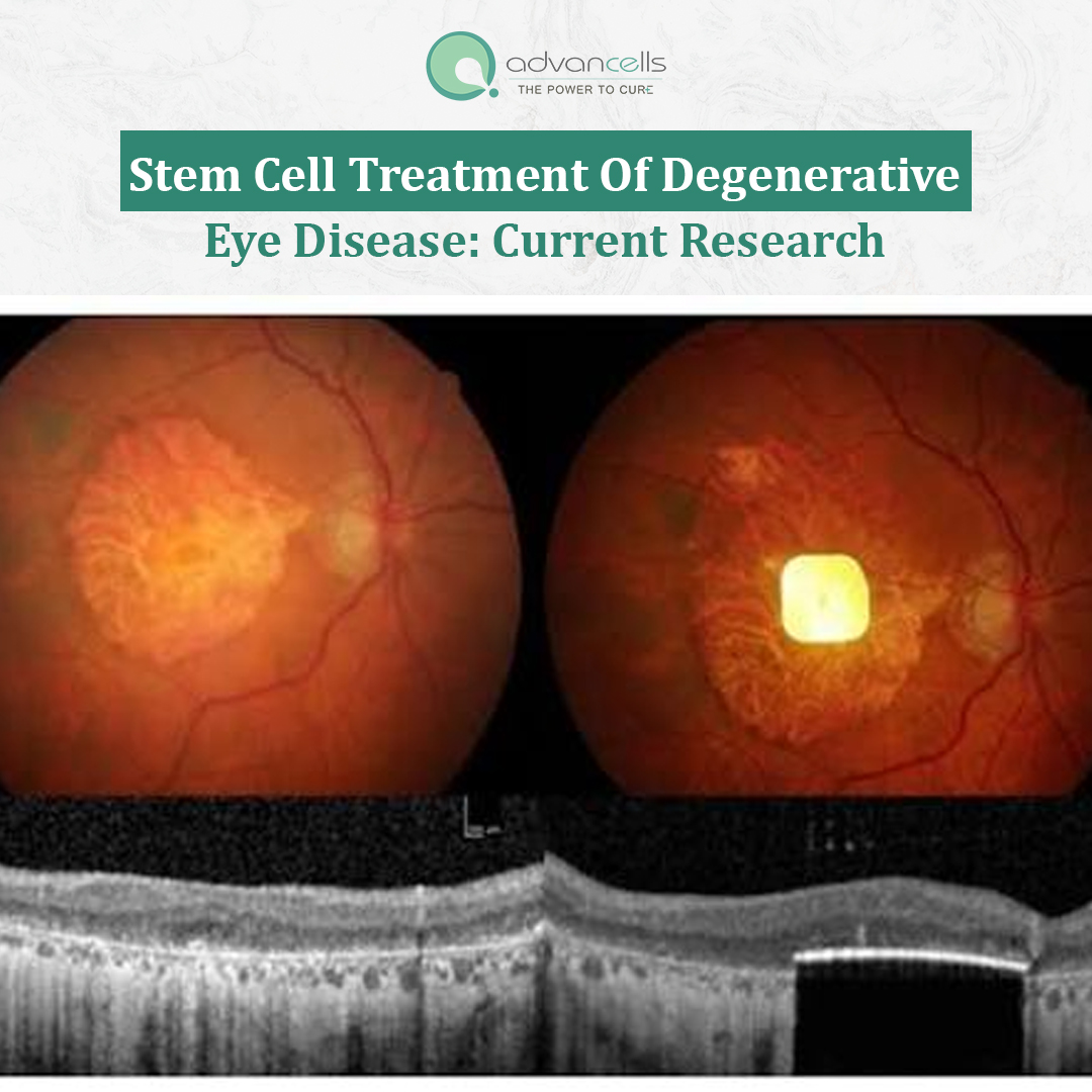  Stem Cell Treatment of Degenerative Eye Disease: Current Research