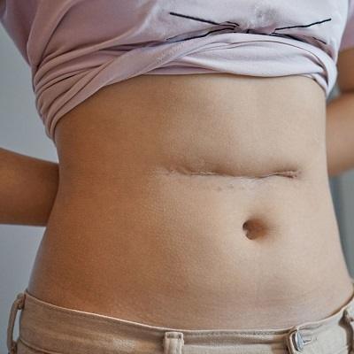  Surgical scar revision in Dubai