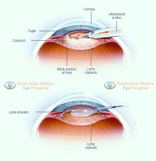  Advanced Cataract Surgery in Rajkot – Keshubhai Mehta Eye Hospital