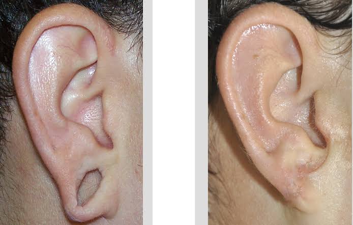  Earlobe Correction Surgery in Dubai