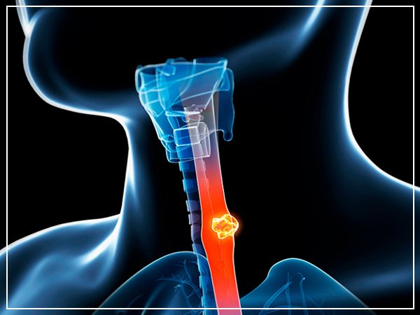  Expert Esophageal Cancer Doctor in Noida | Cancer Consult