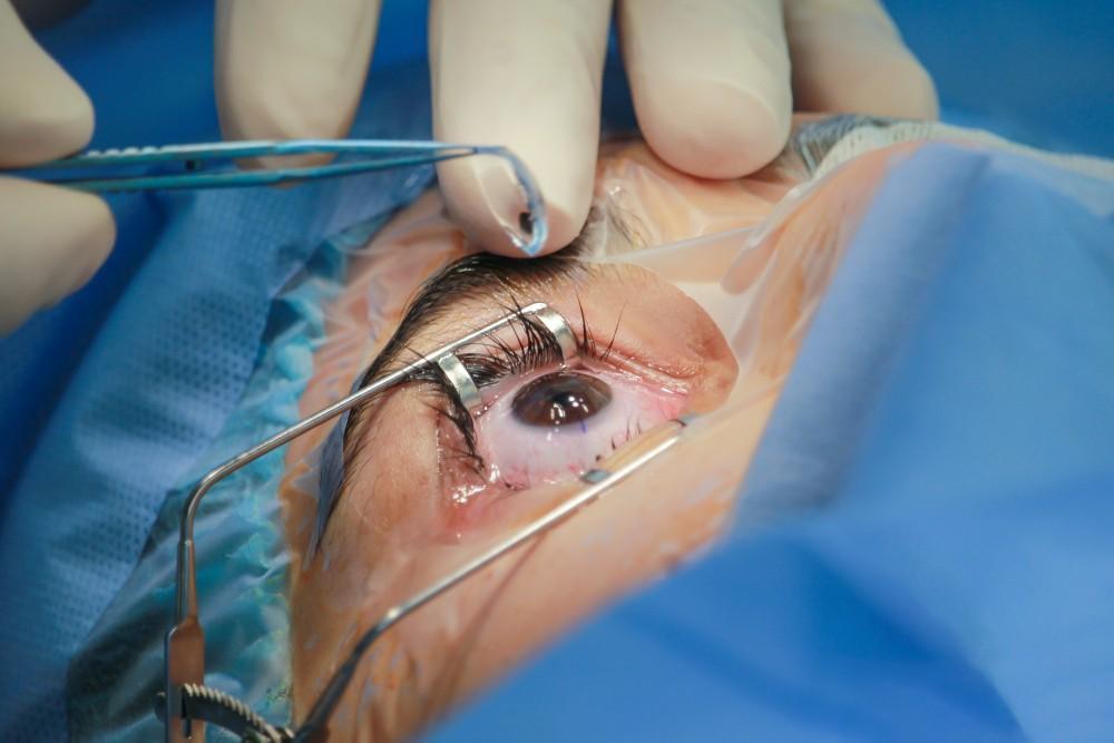  Cataract Surgery in Lucknow | Phaco Surgery & Premium IOLs