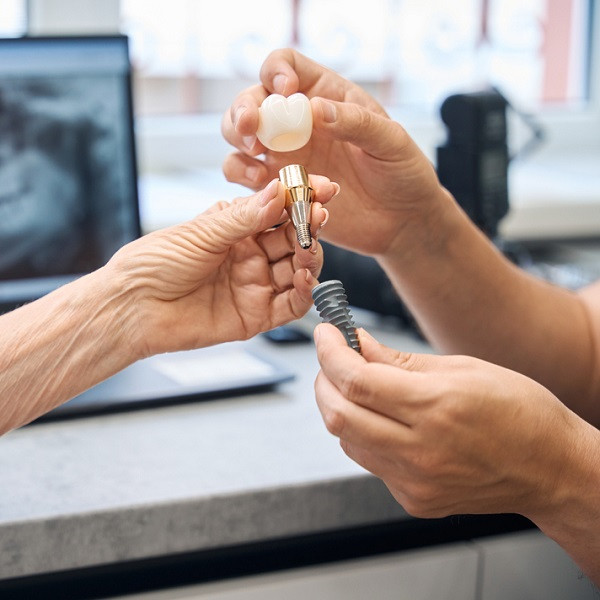  Dental Implants Wellington