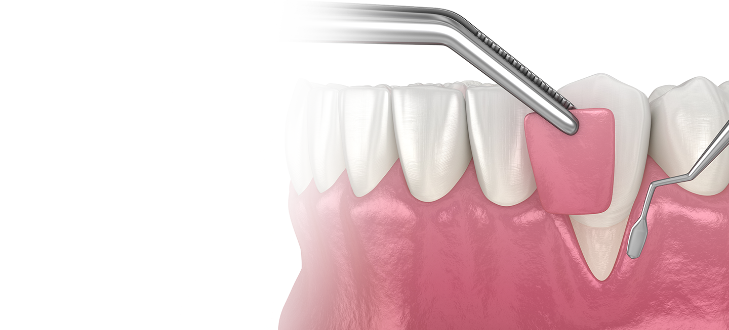  Advanced Gum Care at Agrawal Dental Clinic