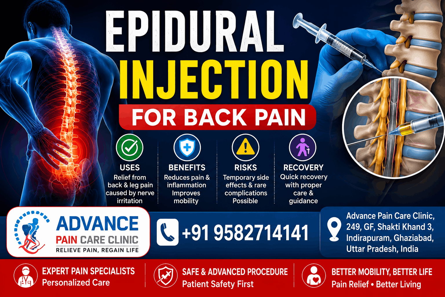  Epidural Injection for Back and Nerve Pain Relief