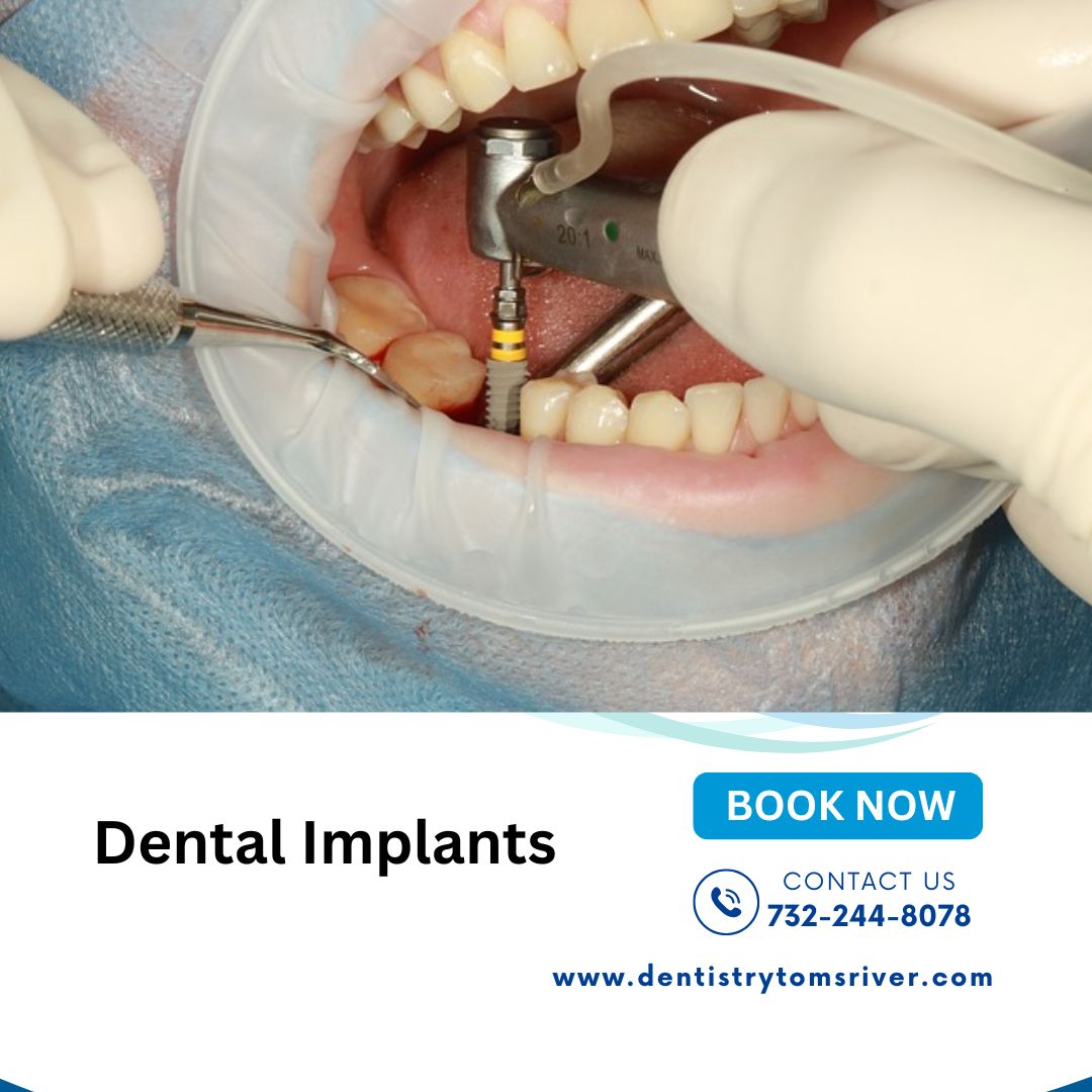  How Long Do Dental Implants Last?