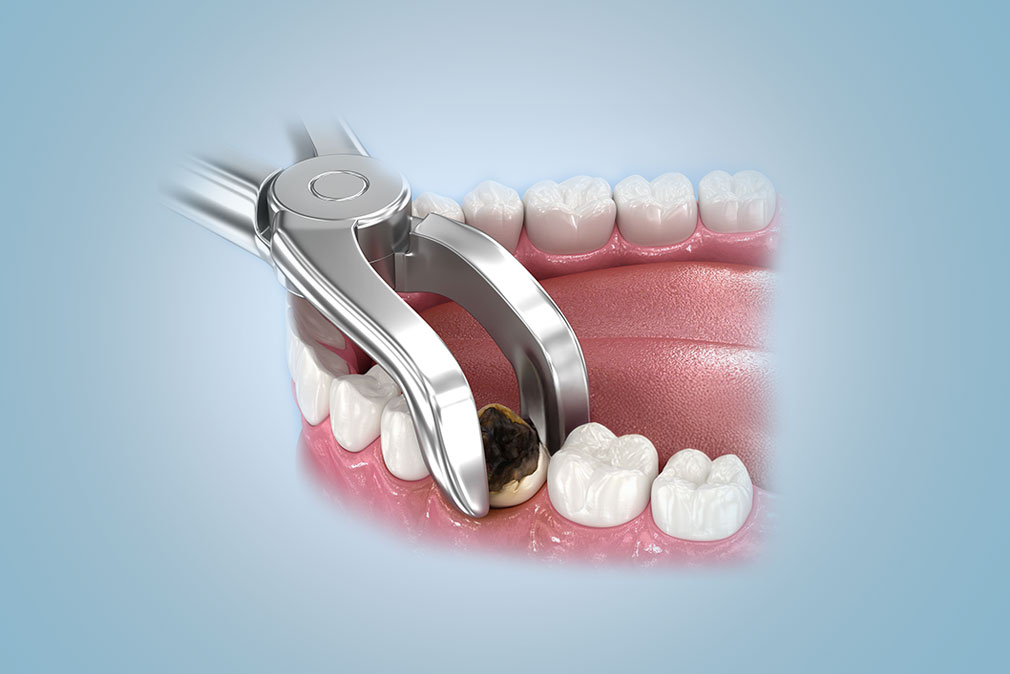  Tooth Extraction Bukit Timah