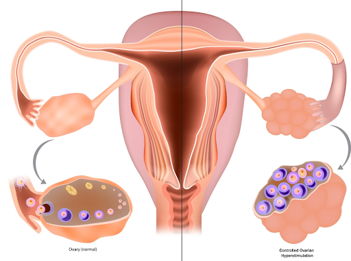  Ovarian Stimulation Treatment in Ahmedabad – Sunflower Hospital